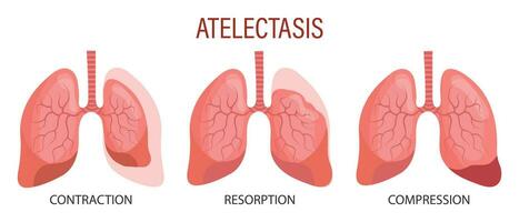 atelectase, een long ziekte. samentrekking, resorptie, compressie. medisch infographic banier, illustratie, vector