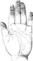 sclerose of sclerotizis van de links hand- palmar oppervlak, vint vector