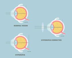 oogbol anatomie, intern organen lichaam een deel nerveus systeem, verziendheid concept, vector illustratie tekenfilm vlak ontwerp klem kunst