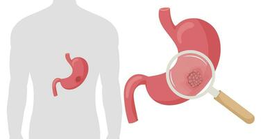 maag kanker. kwaadaardig kankerachtig tumor vergroot onder vergroten glas. anatomisch vector illustratie geïsoleerd wit achtergrond tekenfilm stijl