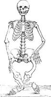 skelet misvormd door rachitis, wijnoogst gravure. vector
