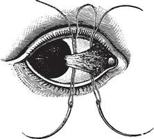 ligatie van pterygium, wijnoogst gravure. vector