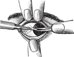 excisie van pterygium, wijnoogst gravure. vector