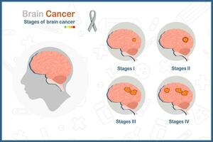 hersenen kanker. medisch vector illustratie in vlak stijl van de vier stadia van hersenen kanker.geïsoleerd Aan wit achtergrond.gezondheid zorg en medisch concepten.