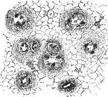 chronisch caseous bronchitis, wijnoogst gravure. vector