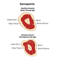 sarcopenie wetenschap ontwerp vector illustratie diagram