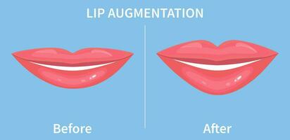 lip vergroting. voordat en na lip vulmiddel injecties. hyaluronzuur zuur injecties. vector illustratie in vlak stijl