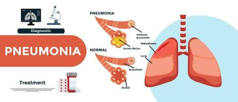 longontsteking. verschil en vergelijking van gezond longen bronchiolen en longblaasjes en longontsteking vector