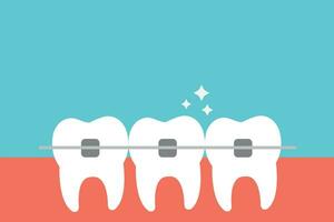 wit tanden met tandheelkundig een beugel vector vlak illustratie. uitlijning van beet van tanden. tandheelkundig kliniek onderhoud, kunstmatig tandheelkunde, tanden rechttrekken, en orthodontisch procedures concept.