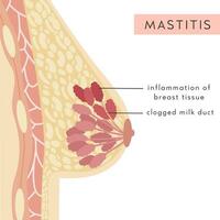 mastitis. medisch infographic kruis sectie van vrouw borst. informatie kaart met pus gevulde klont. anatomie van vrouw borst met infectie. ontsteking van borst klier. pijn. vector illustratie.