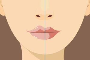 lip vergroting en correctie. lip vulmiddel injecties. hyaluronzuur zuur. schoonheidsspecialiste procedure in een schoonheid salon vector