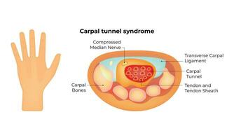 carpaal tunnel syndroom wetenschap ontwerp vector illustratie diagram