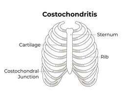 costochondritis wetenschap ontwerp vector illustratie