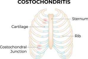 costochondritis wetenschap ontwerp vector illustratie