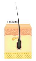 folliculitis wetenschap ontwerp vector illustratie diagram