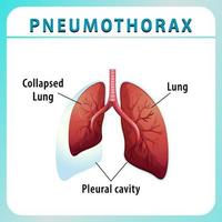 pneumothoraxdiagram met ingeklapte long en gezonde long vector