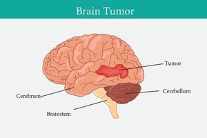 hersenen kanker concept. kwaadaardig tumor ontwikkelt in de menselijk brein. kanker cel structuur. vlak vector illustratie. eps 10