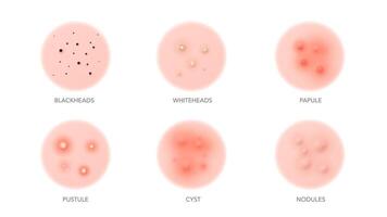 acne soorten, lichaam of gezicht huid puistjes ontsteking vector