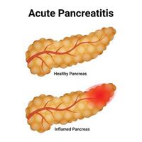 acuut pancreatitis wetenschap ontwerp vector illustratie diagram