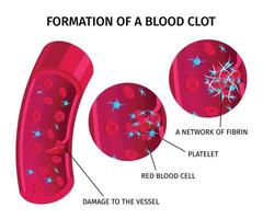 bloedcellen trombus infographics vector