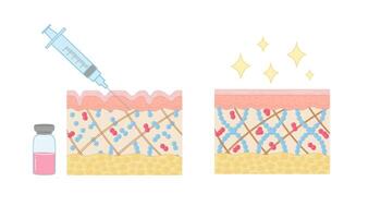 hyauronisch zuur injectie, diagram. illustratie in tekenfilm stijl. vector