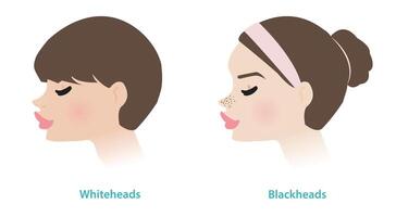 schattig Dames met whiteheads en mee-eters acne Aan neuzen vector illustratie. whiteheads en mee-eters zijn beide types van niet opruiend acne, ze zijn vormen van comedonen. de porie is Gesloten of open.