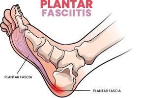 illustratie van plantaris fasciitis diagram vector