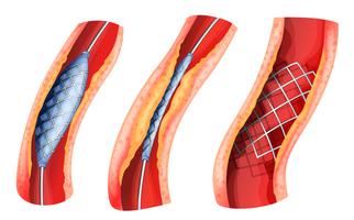 Stent gebruikt om geblokkeerde slagader te openen vector