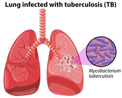 Long besmet met tuberculose vector