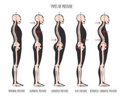 type van houding, posturaal syndromen infografisch. skelet- monsters van terug probleem kyfose, lordose en vlak rug. normaal houding medisch leerzaam poster. vector