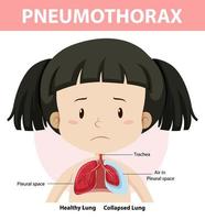 pneumothorax diagram van de menselijke anatomie vector