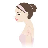 de vrouw met acne Aan bovenste armen illustratie geïsoleerd Aan wit achtergrond. acne, puistjes, mee-eters, comedonen, whiteheads, papel, puisten, knobbel en cyste Aan arm. huid probleem concept. vector