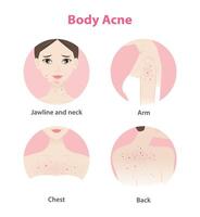 acne Aan gezicht en lichaam vrouw icoon reeks Aan wit achtergrond. puistjes, mee-eters, comedonen, whiteheads, papel, puisten, knobbeltje, cyste Aan kaaklijn, nek, arm, borst en rug. huid probleem concept. vector