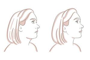 verminderen dubbele kin, kaaklijn plastic en cosmetologie. krijgen ontdoen van gezicht en nek dik voordat en na concept. vector