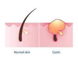 cystic acne, de meest erge, ernstige type van opruiend acne vector Aan wit achtergrond. normaal huid en cyste ontwikkelen pus gevulde puistje diep onder de huid, vaak pijnlijk, groot en naar oorzaak littekens.