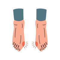 voeten met bunion, orthopedische voorwaarde, probleem met voeten, bot misvorming, hallux valgus illustratie, blootsvoets schoenen brochure, hoog hielden versmallen schoenen Gezondheid risico's, roodheid en ontsteking vector