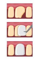 fineer tanden procedure, tandheelkundige vulling op gebroken tand cartoon vlakke afbeelding vector geïsoleerd op witte achtergrond