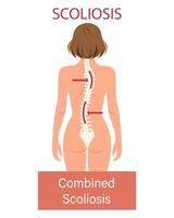 scoliose, een ziekte van de ruggengraat. infographic banier met scoliose van de menselijk ruggengraat. gezondheidszorg en geneesmiddel. illustratie vector