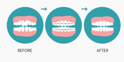 vectorillustratie van stadia van orthodontische behandeling accolades op tanden. tanden voor, na beugel op. achtergrond in vlakke style.vector op blauwe achtergrond. tandheelkundig begrip. vector