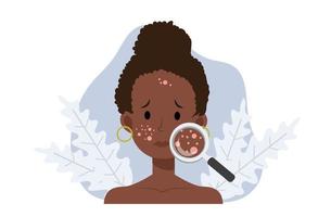 acne huidproblemen concept.african american vrouw met vergrootglas kijkt acne op zijn gezicht. falt cartoon vectorillustratie. vector