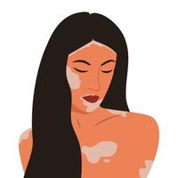 portret van een meisje met vitiligo. illustratie op het thema van wereld vitiligo dag vector