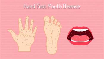 hand voet mond syndroom. coxsackie virus a16, enterovirus 71. vector illustratie eps10