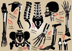 Verzameling van orthopedische chirurgie (interne fixatie met plaat en schroef) (schedel, hoofd, nek, ruggengraat, heiligbeen, arm, onderarm, hand, elleboog, schouder, bekken, dij, heup, knie, been, voet) vector