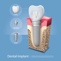Menselijke tanden en tandimplant vectorillustratie vector