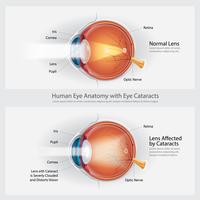cataract visus stoornis en normale oog visie anatomie vector illustratie