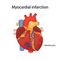 myocardinfarct. illustratie van een menselijk hart. hartaanval. cartoon stijl illustratie vector