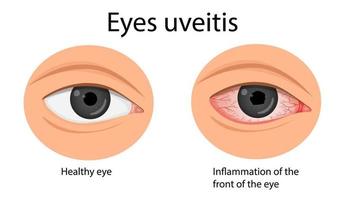 oog irritatie. konyuktevitis, keratitis, allergieën, uveïtis. vector