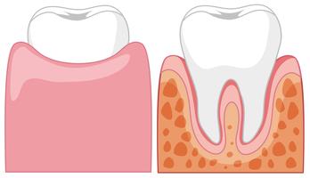 Een cartoon van menselijke tanden