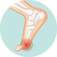 hallux valgus typen in cirkelsjabloon vector