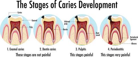 infographic van de mens in de stadia van cariësontwikkeling vector